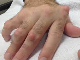 rheumatoid arthritis 